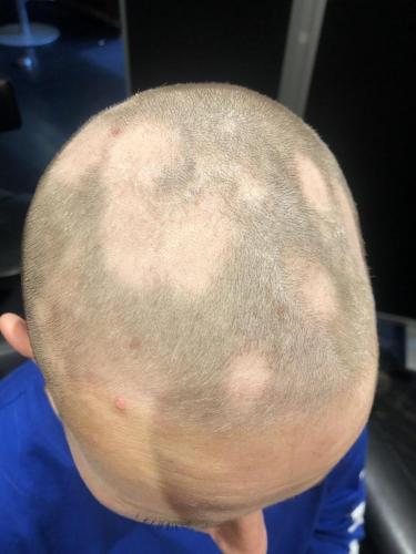 Begyndende hårtab. Hårtab kan komme af flere ting, f.eks. medicin, stress, Alopecia.
